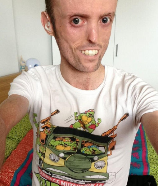 Велосипедист с редчайшим генетическим заболеванием - полное отсутствие жира в организме MDP-синдром, Том Станифорд, без жира, велосипедист