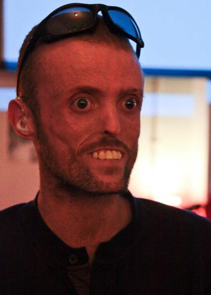 Велосипедист с редчайшим генетическим заболеванием - полное отсутствие жира в организме MDP-синдром, Том Станифорд, без жира, велосипедист