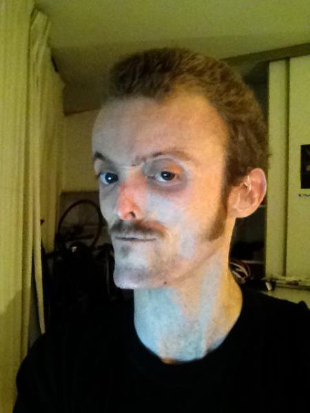 Велосипедист с редчайшим генетическим заболеванием - полное отсутствие жира в организме MDP-синдром, Том Станифорд, без жира, велосипедист