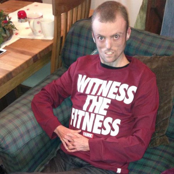 Велосипедист с редчайшим генетическим заболеванием - полное отсутствие жира в организме MDP-синдром, Том Станифорд, без жира, велосипедист